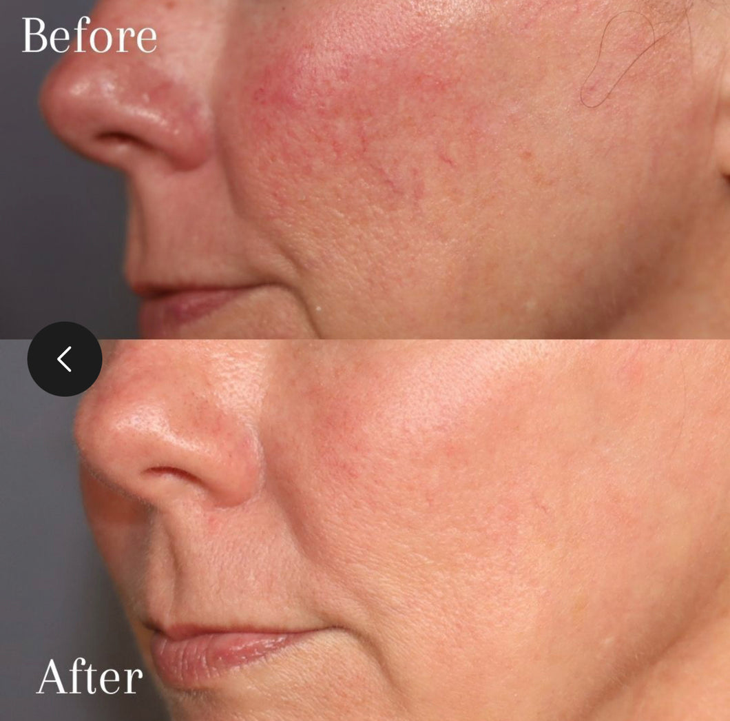 hydroquinone cream before after